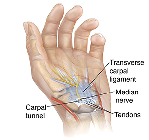 What is Carpal Tunnel Syndrome?