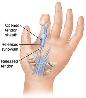 Trigger finger steroid injection treatment