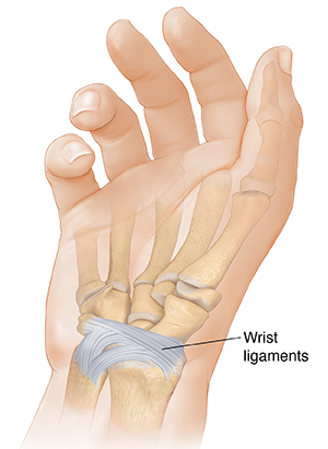 Treating Wrist Sprains