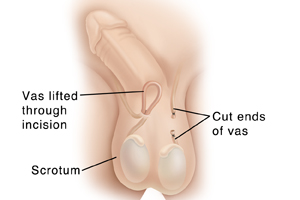 penis and scrotum with penis pointing up to show underside testicles visible in scrotum vas on left side is cut and tied above