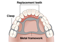 partial denture dentures framework metal clasp clasps teeth roof kiss dental mouth showing around