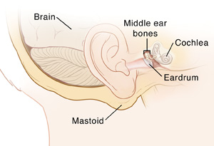 mastoidectomy types