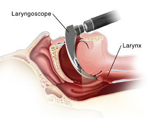 What about laryngoscopy?