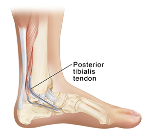 Posterior tibial tendonitis inserts sale