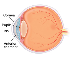 What is iritis of the eye?