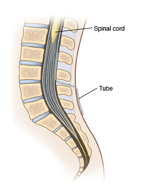 Epidural continuous infusion kit - BD