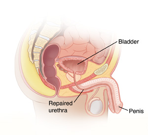 Urethroplasty  Saint Luke's Health System