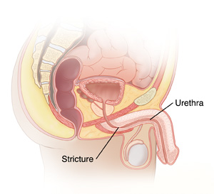 Urethroplasty  Saint Luke's Health System