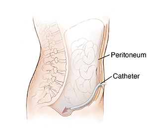 About Intraperitoneal (IP) Chemotherapy