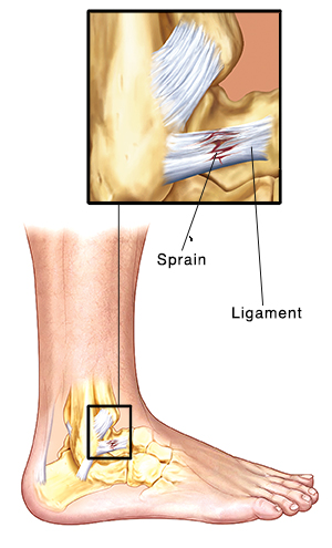 Self-Care for Strains and Sprains | Saint Luke's Health System