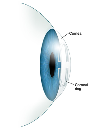 Understanding Corneal Ring Implantation Saint Luke S Health System