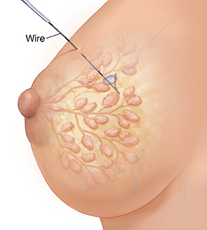 Open Breast Biopsy: Before Your Surgery