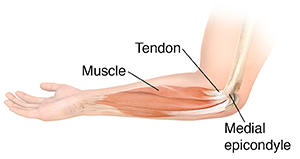 Medial epicondylitis