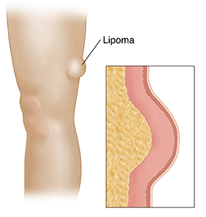 Lumps Under Skin (that Move): Lipomas and Other Causes