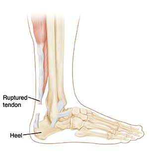 Achilles Tendon Rupture Saint Luke S Health System