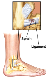 ligament strains