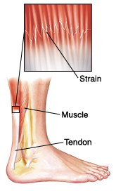 leg muscle strain