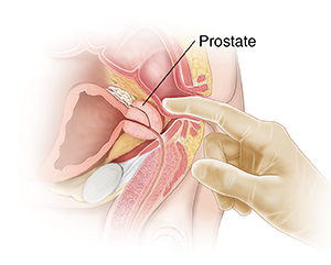 Prostatitis férfiakban és rákban, Prosztatagyulladás
