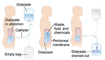 Peritoneal Dialysis (pd) 