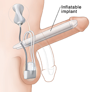 Surgery for Erectile Dysfunction Implants Saint Luke s Health