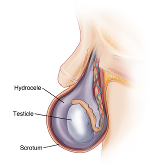 CRETO Scrotal Support,for varicocele and hydrocele lift to the