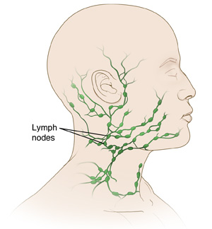 Cervical lymph node biopsy