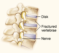 Vertebroplasty | Saint Luke's Health System