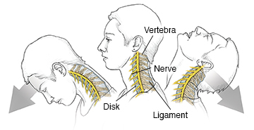 Whiplash | Saint Luke's Health System