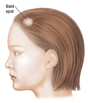 Understanding Alopecia Areata Saint Luke S Health System