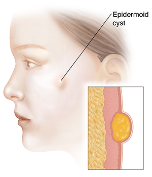 Understanding Epidermoid Cyst Saint Luke S Health System