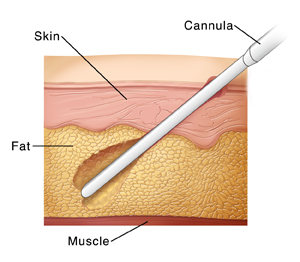 Liposuction | Saint Luke's Health System