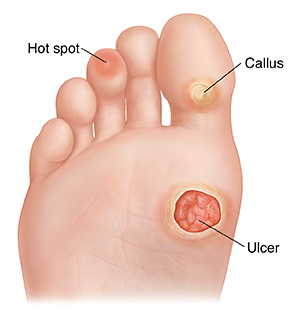 What Are Pressure Injuries Of The Foot Saint Luke S Health System