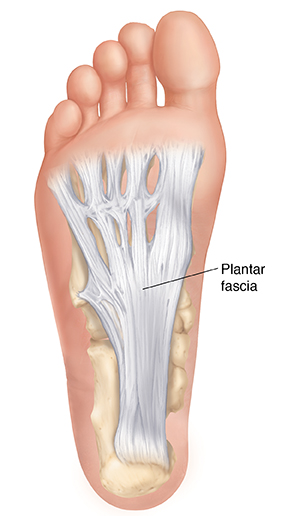 Is it Plantar Fasciitis?