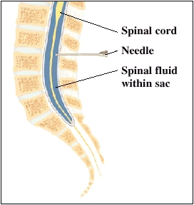 Lumbar Puncture | Saint Luke's Health System