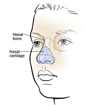 Nasal fractures are more common in... 