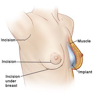Breast Implant Surgery (Augmentation)