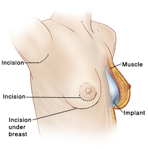 Breast Implant Placement: Over vs Under the Chest Muscle