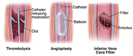 Advances in Treating Deep Vein Thrombosis