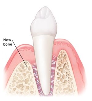 Periodontal Disease: Guided Tissue Regeneration (GTR) | Saint Luke's ...