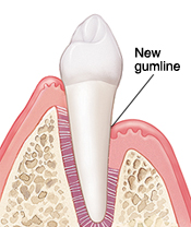 Tooth in cross section of gum and bone. Gumline is lower on tooth after healing from surgery.