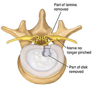 Microdiscectomy | Saint Luke's Health System