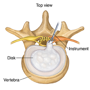 Types of Lumbar Disk Surgery | Saint Luke's Health System