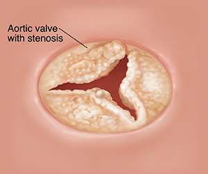 Cross section of heart showing aortic valve with stenosis. 
