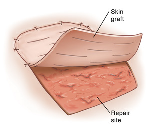 Vue de dessus de la greffe de peau utilisée pour réparer un site de plaie.