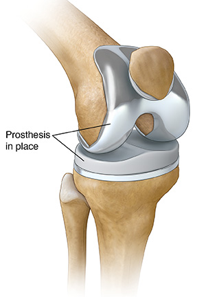 What Not To Do After Knee Replacement