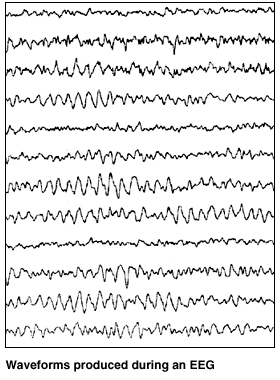 Eeg Normal Waveforms – Basics (Part I) – LHAHG