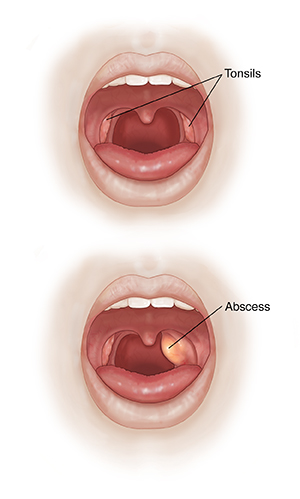 how to drain a tooth abscess at home with a needle