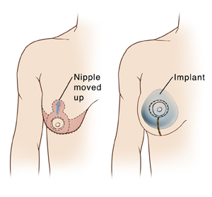 Will a Breast Implant Lift My Breast?
