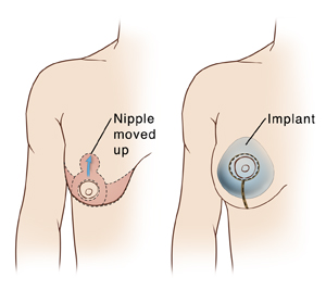 Types of Breast Implants: Which One is Right for You?