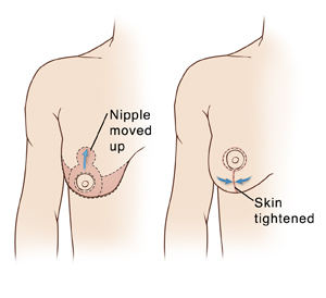 Your nipples and breast reduction